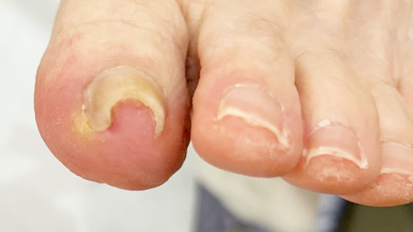 爪の違和感・切りにくさ 初回チェック相談の画像