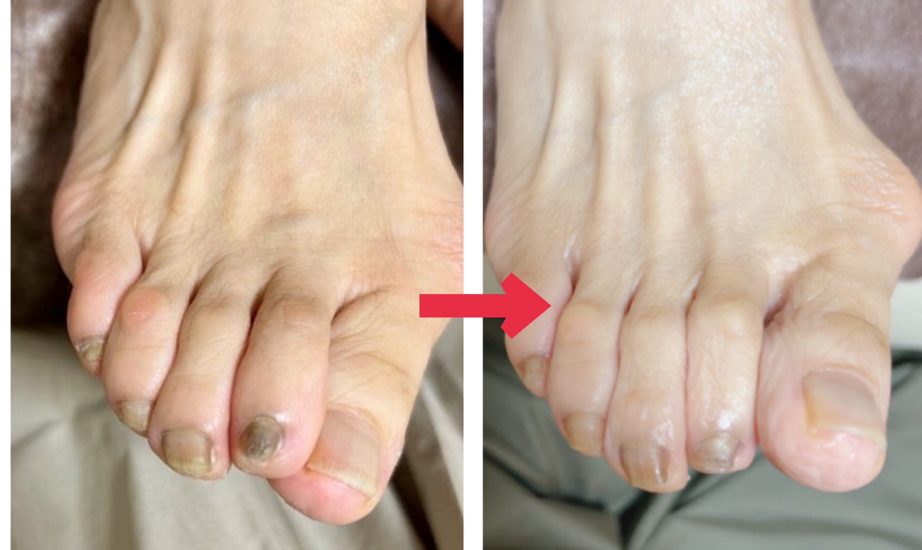 「外反母趾まわりの爪トラブル相談」 （変形爪・タコ・魚の目が気になり始めた方へ）の画像