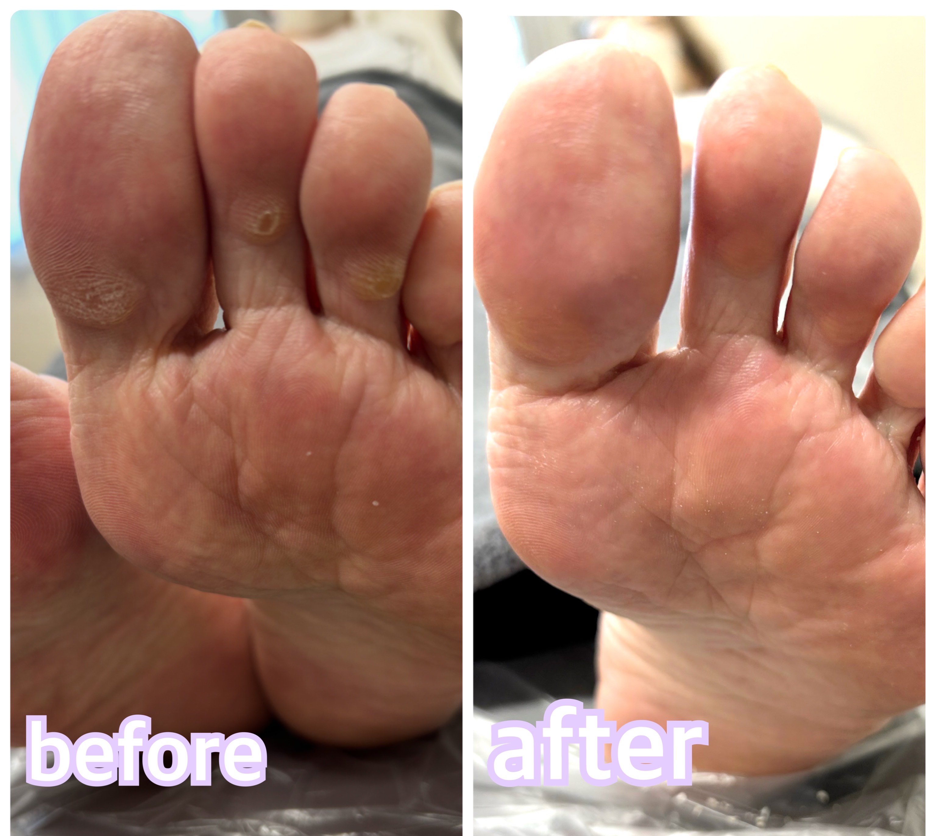 【全員】足裏トラブルお悩みケアの画像