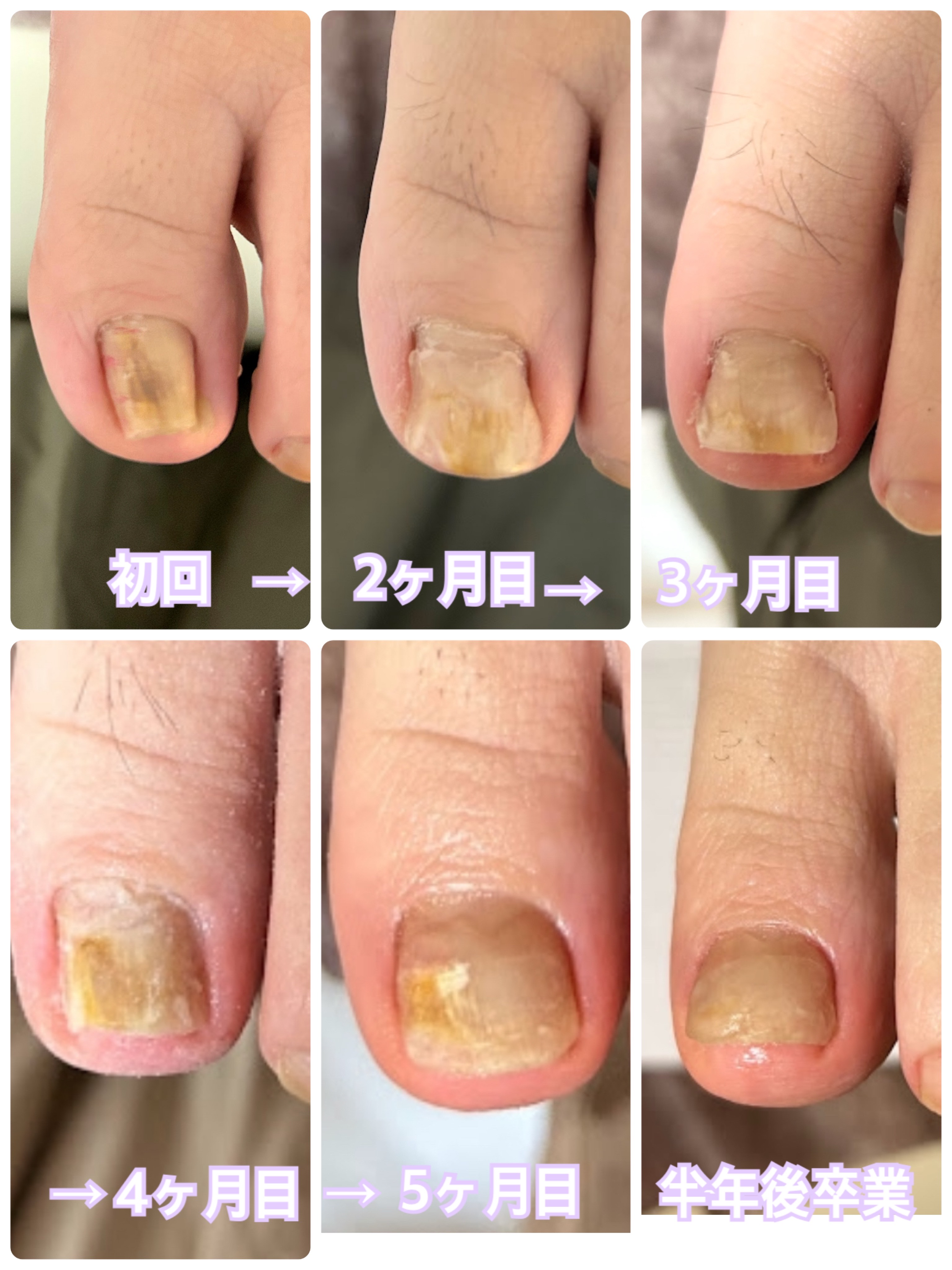 【全員】巻き爪補正　親指1本の画像