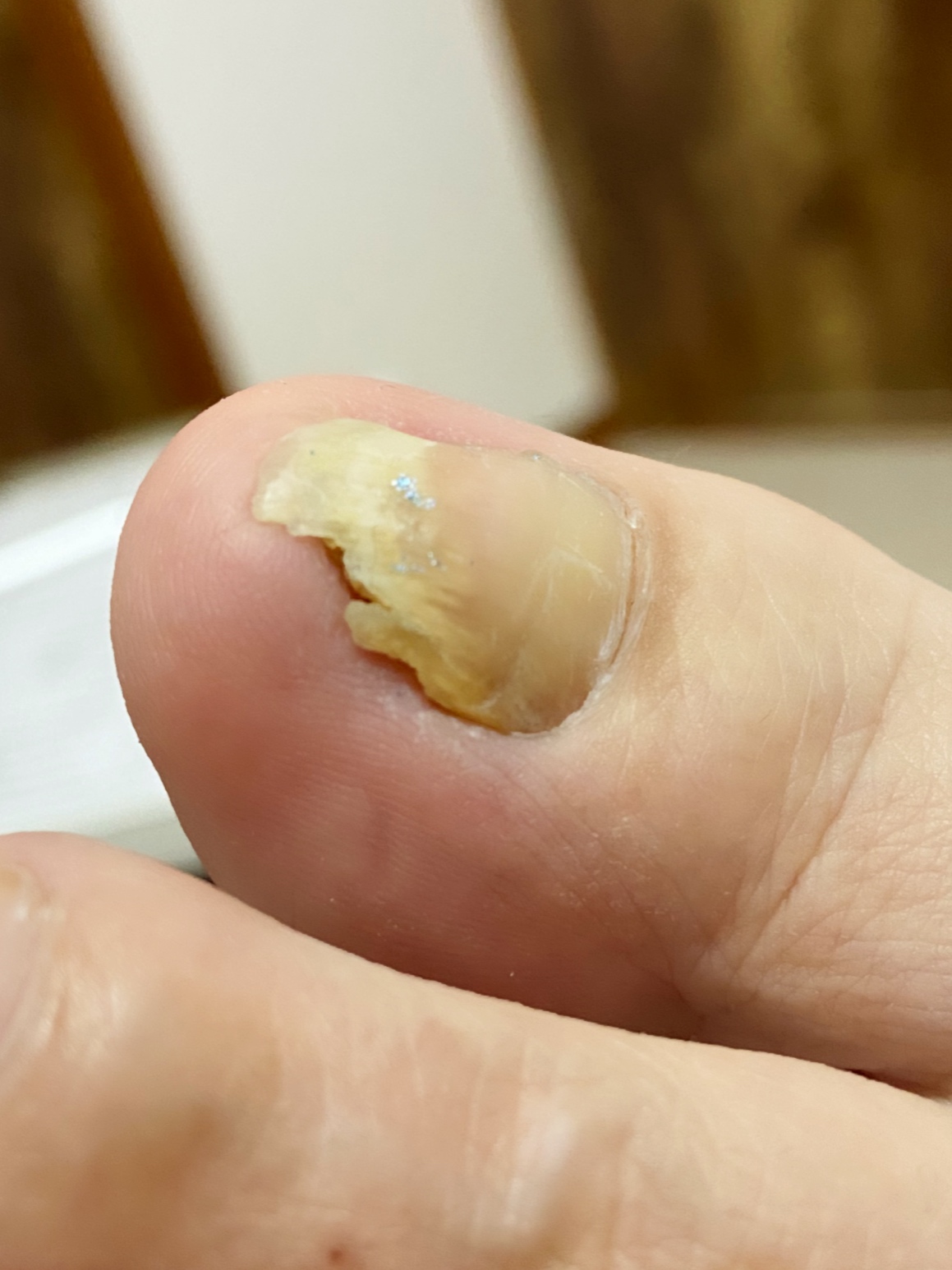 【初回】変形した爪のケアの画像